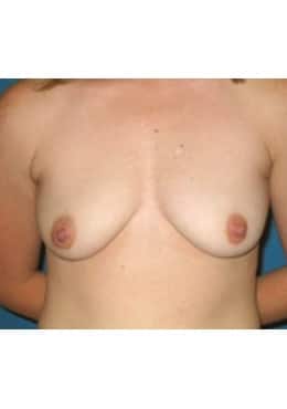 Breast Lift