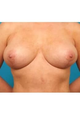 Breast Lift