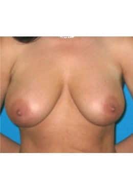 Breast Lift