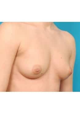 Before Image: Breast Augmentation - oblique right