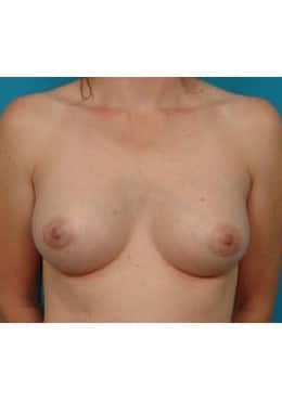 Breast Augmentation