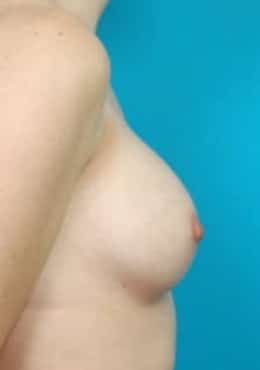After Image: Breast Augmentation - right