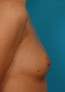Before Image: Breast Augmentation - right