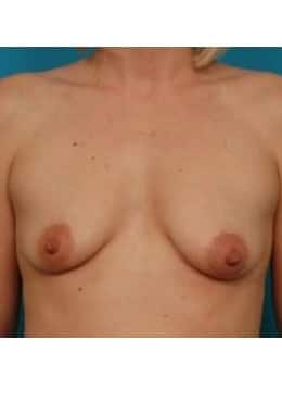 Before Image: Breast Augmentation - front