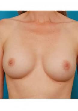 After Image: Breast Augmentation - front