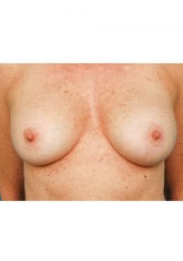 After Image: Breast Augmentation - front