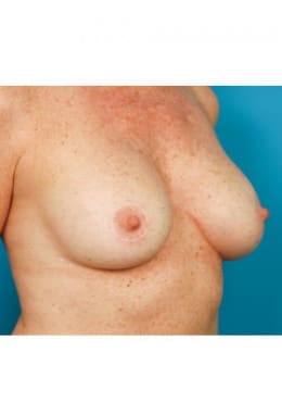 After Image: Breast Augmentation - oblique right