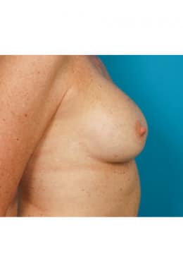 After Image: Breast Augmentation - right