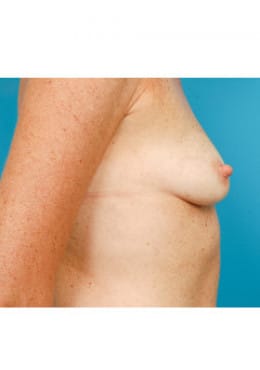 Before Image: Breast Augmentation - right