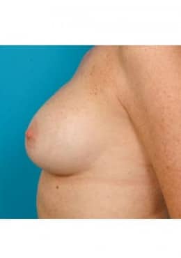 After Image: Breast Augmentation - front