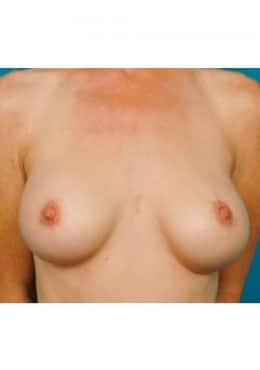 After Image: Breast Augmentation - front
