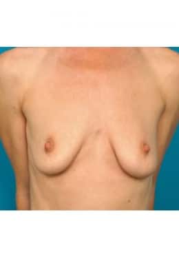 Before Image: Breast Augmentation - front