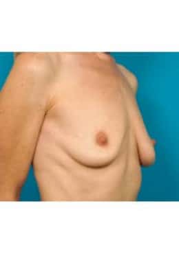 Before Image: Breast Augmentation - oblique right