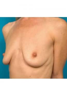 Before Image: Breast Augmentation - oblique left