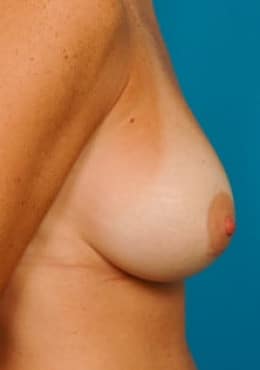 After Image: Breast Augmentation - right