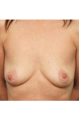 Breast Augmentation