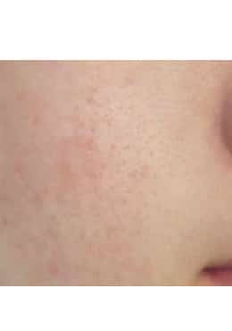 After Image: Microneedling with Radio Frequency - close-up