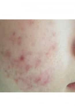 Before Image: Microneedling with Radio Frequency - close-up