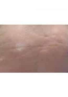 After Image: Microneedling with Radio Frequency - close-up
