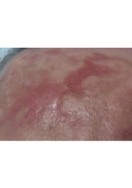 Before Image: Microneedling with Radio Frequency - close-up