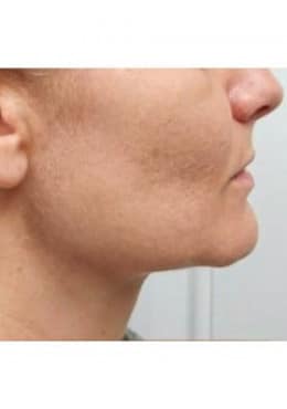 Microneedling with Radio Frequency