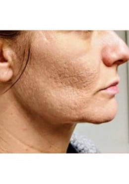 Before Image: Microneedling with Radio Frequency - close-up