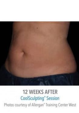 After Image: CoolSculpting - oblique left