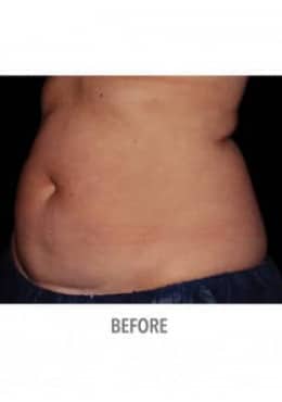 Before Image: CoolSculpting - oblique left