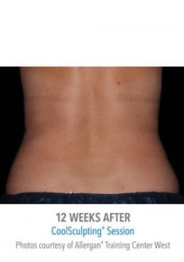 After Image: CoolSculpting - back
