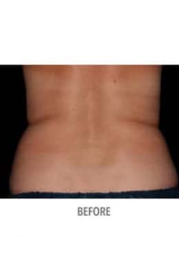 Before Image: CoolSculpting - back