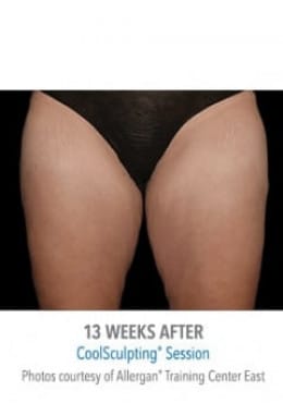 After Image: CoolSculpting - front