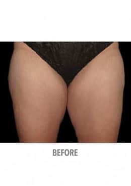 Before Image: CoolSculpting - front