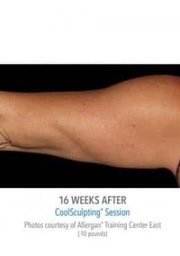 After Image: CoolSculpting - left