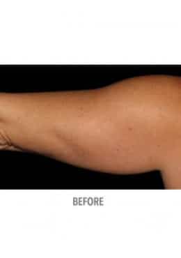 Before Image: CoolSculpting - left