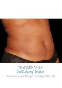 CoolSculpting