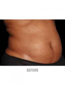 CoolSculpting