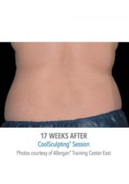 CoolSculpting