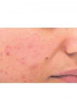 PCA Chemical Peel – Acne Treatment