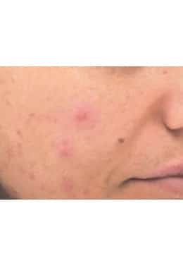 PCA Chemical Peel – Acne Treatment