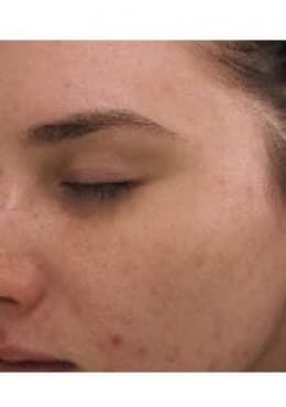 PCA Chemical Peel – Acne Treatment