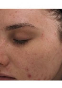 PCA Chemical Peel – Acne Treatment