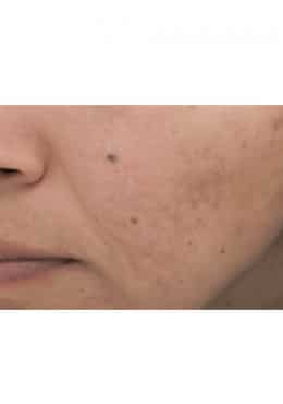 PCA Chemical Peel – Acne Treatment