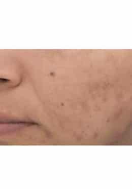 PCA Chemical Peel – Acne Treatment