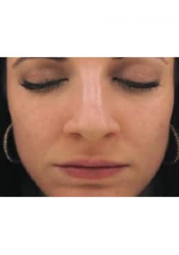 PCA Chemical Peel – Acne Treatment