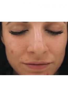 PCA Chemical Peel – Acne Treatment