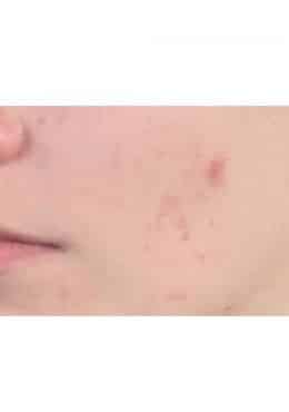 PCA Chemical Peel – Acne Treatment