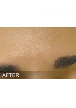 After Image: HydraFacial - close-up