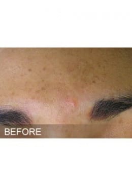Before Image: HydraFacial - close-up