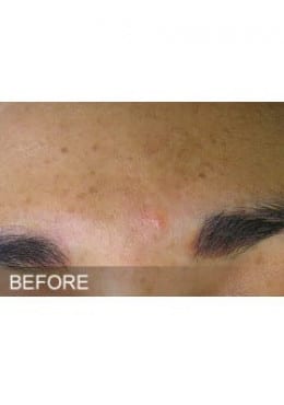 HydraFacial