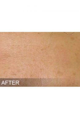 After Image: HydraFacial - close-up